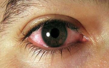 این تغییرات در چشم زنگ خطر بیماری قلبی است