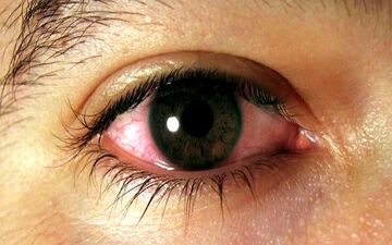 این تغییرات در چشم زنگ خطر بیماری قلبی است