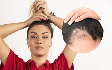 این مدل موهای محبوب می‌توانند باعث ریزش مو شوند