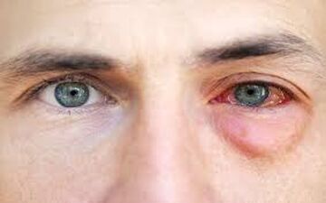  آلرژی چشمی چگونه درمان میشود؟
