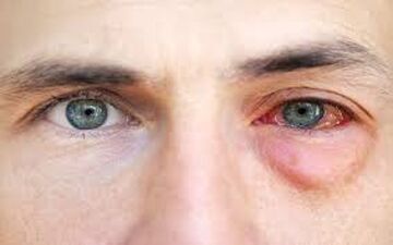  آلرژی چشمی چگونه درمان میشود؟