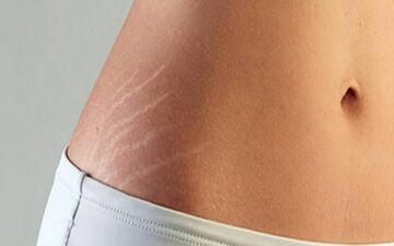 چطور ترک‌های پوستی را از بین ببریم؟