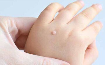 چگونه می توان از انتقال HPV به نوزاد جلوگیری کرد؟