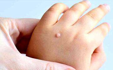 چگونه می توان از انتقال HPV به نوزاد جلوگیری کرد؟