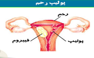 پولیپ رحم چیست؟ علت و علائم آن را بدانید