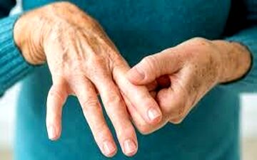 خشکی مفاصل در ابتدای روز یکی از مهمترین علائم این بیماری است 