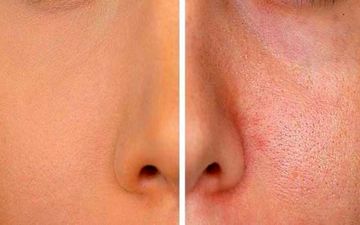 میخوای از شر منافذ باز پوستت خلاص بشی؟ اینجا رو بخون