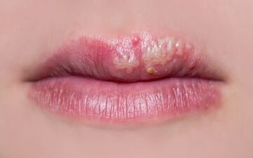 تبخال را سه دقیقه ای ناپدید کنید