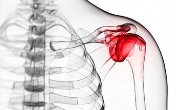 شانه یخ‌زده چیست؟+ علل و روند ایجاد بیماری