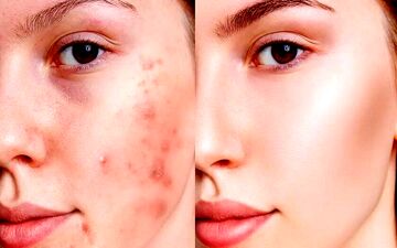 پنج ماده‌ای که به مبارزه با آکنه کمک می‌کند