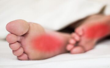 علل داغی کف پا  + راهکارهای درمانی