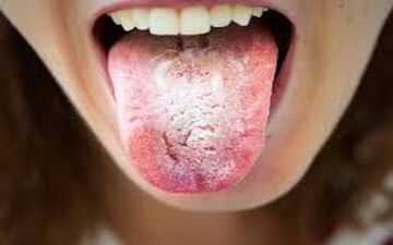 دلیل سفیدی روی زبان و بوی بد دهان چیست؟ راهکار درمانی آن چیست؟