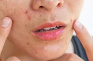 راهنمای سلامت پوست در بهار؛ از مدیریت استرس تا پاکسازی‌های تخصصی

