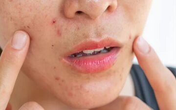 راهنمای سلامت پوست در بهار؛ از مدیریت استرس تا پاکسازی‌های تخصصی

