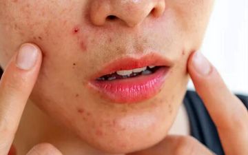 راهنمای سلامت پوست در بهار؛ از مدیریت استرس تا پاکسازی‌های تخصصی


