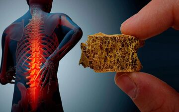 پوکی استخوان را چگونه درمان کنیم؟

