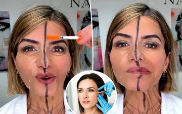 تزریق بوتاکس فقط به یک سمت صورت؛ آزمایشی متفاوت برای نمایش تأثیر واقعی +عکس