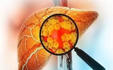 رابطه  PCOS با ابتلا به  کبد چرب!