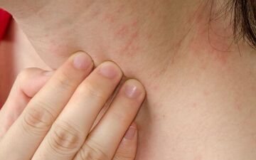 برای جلوگیری از عرق سوز شدن چه کنیم؟