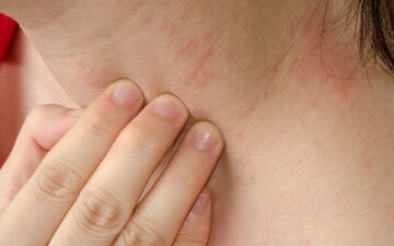 برای جلوگیری از عرق سوز شدن چه کنیم؟