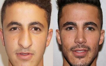  تغییرات باورنکردنی در چهره مردان؛ عمل‌ زیبایی فقط برای خانم‌ها نیست!