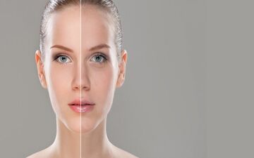 ماسک های خانگی معجزه کننده برای رفع جوش صورت