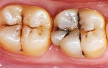  شایع‌ترین بیماری عفونی جهان در دهان شما