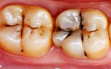  شایع‌ترین بیماری عفونی جهان در دهان شما