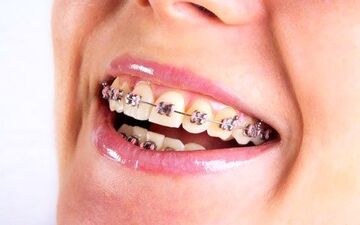  همه انچه باید درباره ارتودنسی بدانید