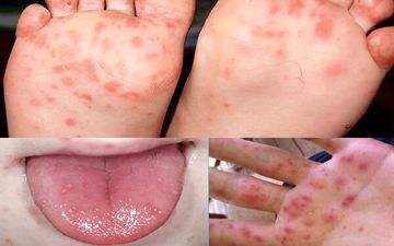 
چگونگی ابتلا به بیماری HFMD 