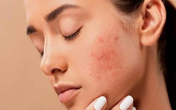 راهکارهایی برای جلوگیری از جوش زدن در بزرگسالی