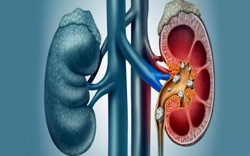 چگونه با مصرف آب کافی از سنگ کلیه پیشگیری کنیم؟