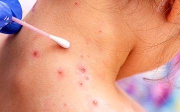 
آیا باید از آبله میمونی بترسی؟
