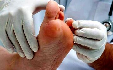از چالش ها تا راهکارهای درمانی زخم پای دیابتی
