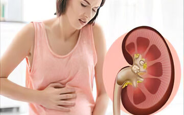 کلیه ات سنگ سازه؟ بیا تا بهت بگم چطور درمانش کنی!