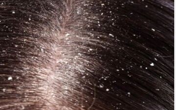 برای برطرف کردن مشکل شوره سر چکار کنیم؟