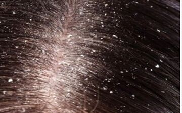 برای برطرف کردن مشکل شوره سر چکار کنیم؟