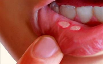 علت و علائم آفت دهان و درمان سریع و خانگی