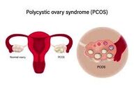ارتباط PCOS  با کبد چرب