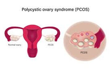 ارتباط PCOS  با کبد چرب