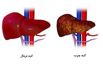 این علائم نشان‌دهنده کبد چرب هستند