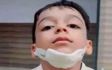 وحشت در کلاس درس؛ معلم کهنوجی با سیلی فک دانش‌آموز شش ساله را شکست+عکس 
