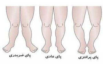  ایجاد پای پرانتزی و صافی کف پا در کودکان به چه علت است؟