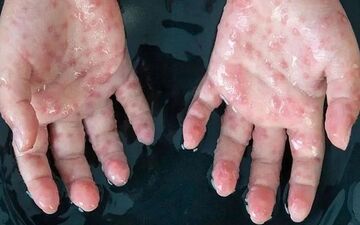 رئیس جمهوری آمریکا خواستار نگرانی همگانی درباره آبله میمونی شد