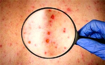 شباهت علائم آبله میمونی و آبله مرغان