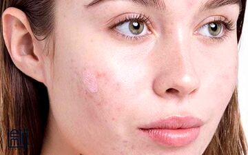 عادت هایی که جوش‌های صورت را بیشتر می‌کنند