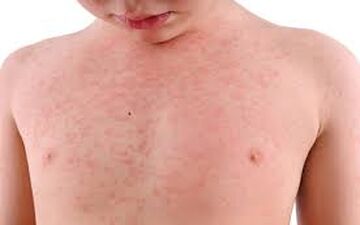  ترفند هایی فوری برای درمان عرق سوز !
