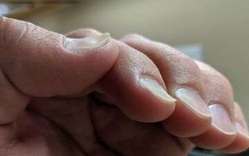 از روی شکل و رنگ ناخن پی به بیماری تان ببرید