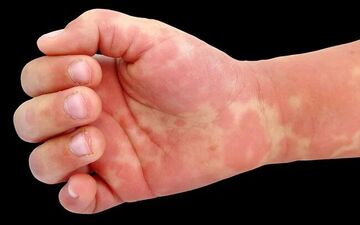 بیماری کاوازاکی چیست؟ | کاوازاکی بیماری خفته در کودکان