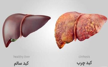 پایان کبد چرب/ قدرت شگفت‌انگیز انتخاب‌های روزمره شما!